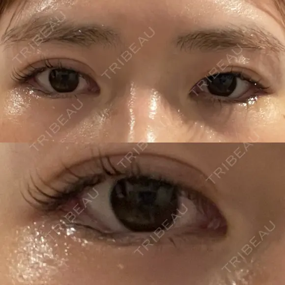 目尻切開 / タレ目形成・グラマラスライン（埋没） / 美容点滴・美容注射（美肌） LOUIS CLINIC 二子玉川院【ルイクリニック】 DAY 2 メイン用