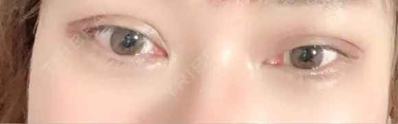 二重埋没 / 自然癒着法 東京シンデレラ美容外科 池袋院 DAY 14 メイン用