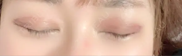 二重埋没 / 自然癒着法 東京シンデレラ美容外科 池袋院 DAY 14 メイン用