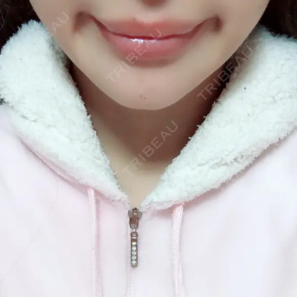 骨切り（あご） / 輪郭修正 / 脂肪溶解注射（顔） 心斎橋コムロ美容外科クリニック DAY 107 メイン用