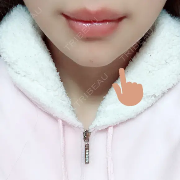 骨切り（あご） / 輪郭修正 / 脂肪溶解注射（顔） 心斎橋コムロ美容外科クリニック DAY 107 メイン用