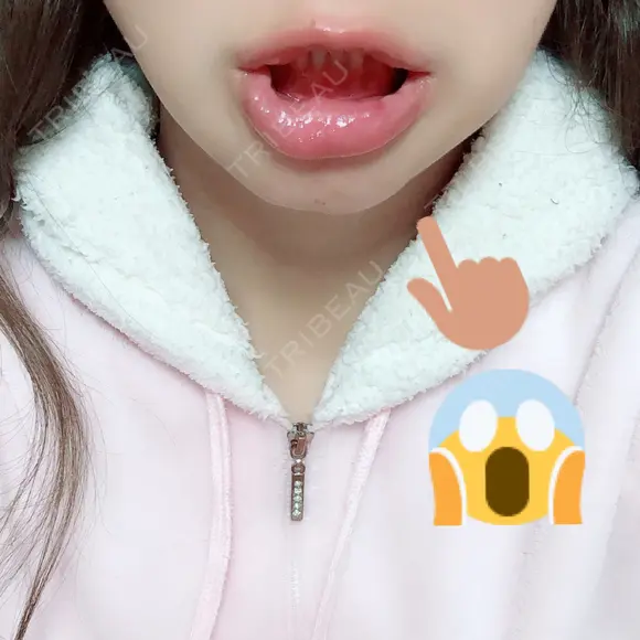 骨切り（あご） / 輪郭修正 / 脂肪溶解注射（顔） 心斎橋コムロ美容外科クリニック DAY 107 メイン用