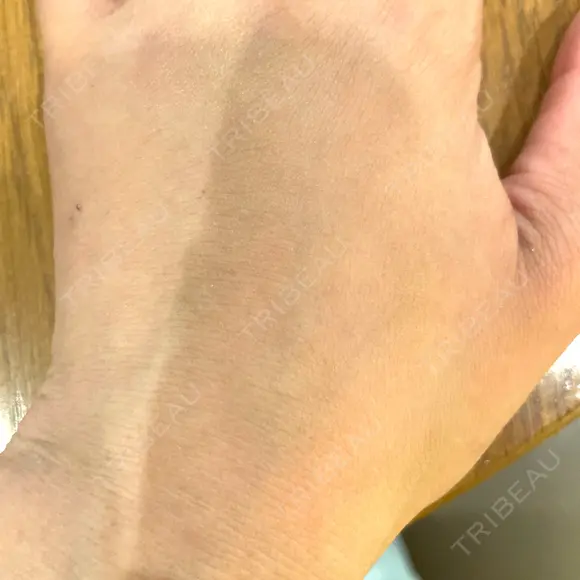 脂肪注入（肌） EMMO FACE CLINIC 大阪梅田院 AFTER メイン用