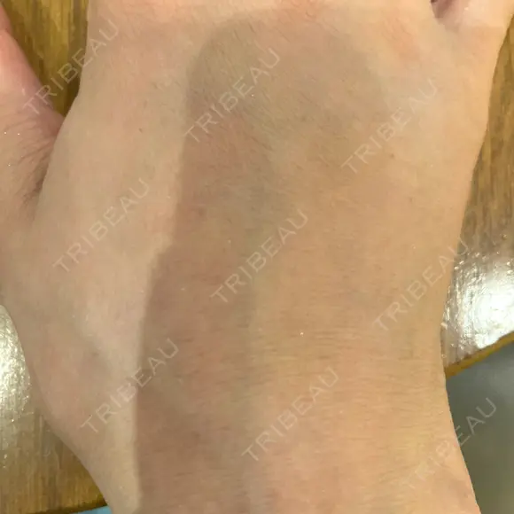 脂肪注入（肌） EMMO FACE CLINIC 大阪梅田院 DAY 19 メイン用