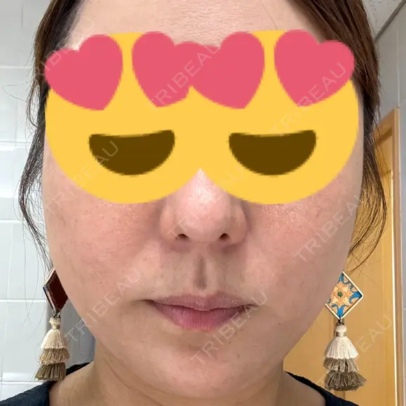 糸リフト BON BON CLINIC 銀座駅前本院 DAY 11 メイン用