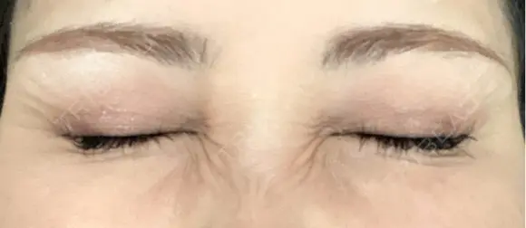 ボトックス（目尻） TCB東京中央美容外科 枚方院 DAY 4 メイン用