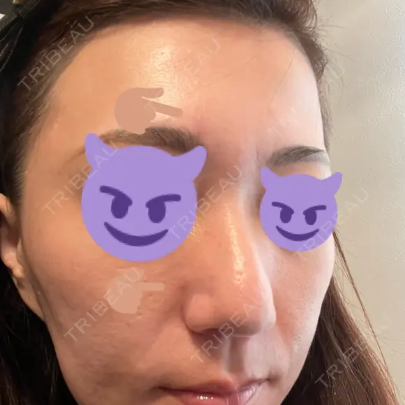 ポテンツァ 渋谷美容外科クリニック 横浜院 AFTER メイン用