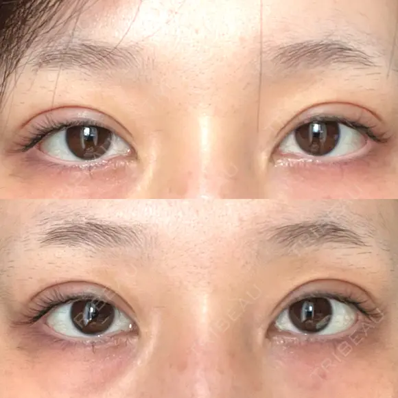 二重埋没 BELINDA CLINIC（ベリンダクリニック）新宿院 DAY 58 メイン用