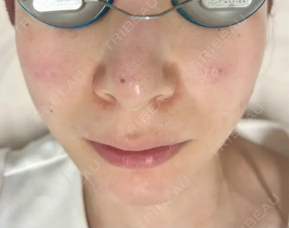 ピコスポット G MEDICAL ART クリニック 新宿院 DAY 0 メイン用