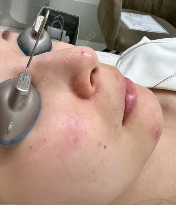 ピコスポット G MEDICAL ART クリニック 新宿院 DAY 0 メイン用