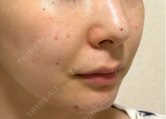 ピコスポット G MEDICAL ART クリニック 新宿院 DAY 1 メイン用