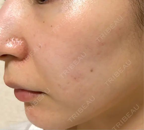 ピコスポット G MEDICAL ART クリニック 新宿院 DAY 9 メイン用
