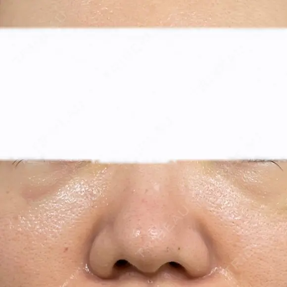 クマ治療 / ヒアルロン酸注入（目の下） ROOTS Clinic DAY 2 メイン用