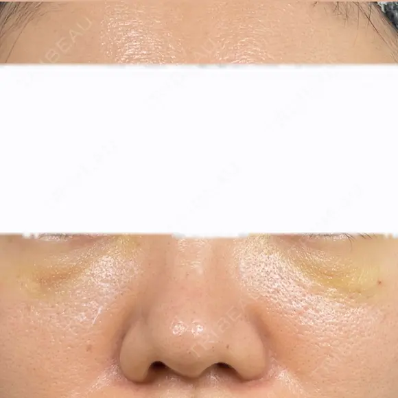 クマ治療 / ヒアルロン酸注入（目の下） ROOTS Clinic DAY 3 メイン用