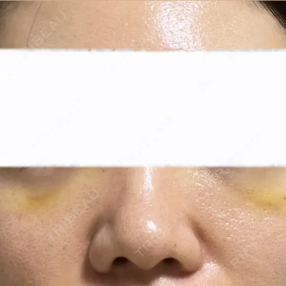 クマ治療 / ヒアルロン酸注入（目の下） ROOTS Clinic AFTER メイン用