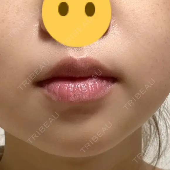 ボトックス（あご） / ボトックス（口角） ルラ美容クリニック 名古屋本院 AFTER メイン用
