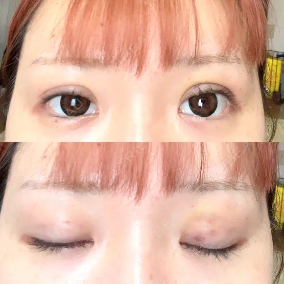 二重埋没 ROOTS Clinic DAY 5 メイン用