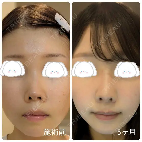 隆鼻術 / 鼻尖形成（切開） / 小鼻縮小（切開） / 軟骨移植 / 鼻柱下降・鼻唇角形成（猫手術） / ボトックス（エラ・小顔） / 毛穴洗浄（ハイドラフェイシャルなど） グローバルビューティークリニック 大阪院 DAY 154 メイン用