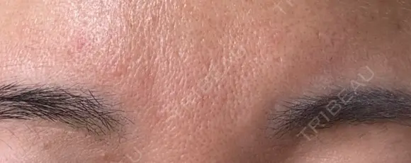 ボトックス（眉間） TCB東京中央美容外科 倉敷院 DAY 0 メイン用