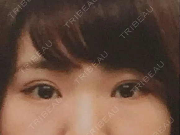 二重切開 / 上まぶたの脂肪取り 樹のひかり 形成外科・皮ふ科 DAY 103 メイン用