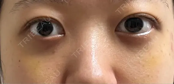 下まぶたの脂肪取り APOLLO BEAUTY CLINIC DAY 12 メイン用