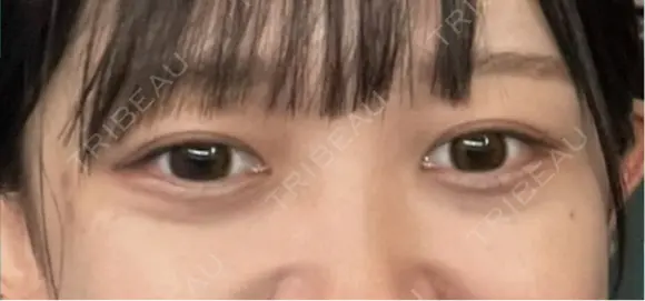 下まぶたの脂肪取り APOLLO BEAUTY CLINIC DAY 17 メイン用