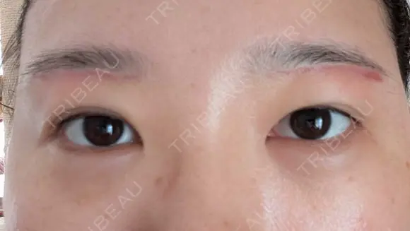 上まぶたたるみ取り / ダーマペン / 毛穴洗浄（ハイドラフェイシャルなど） Leap beauty clinic DAY 39 メイン用