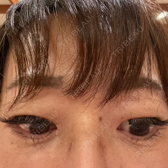 下まぶたたるみ取り / 下まぶたの脂肪取り / 脂肪注入（目の下） 湘南美容クリニック 千葉センシティ院 AFTER メイン用