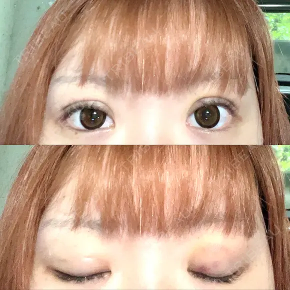 二重埋没 ROOTS Clinic DAY 6 メイン用