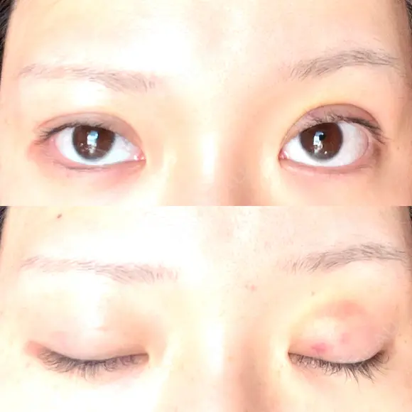 二重埋没 ROOTS Clinic DAY 7 メイン用