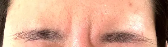 ボトックス（眉間） TCB東京中央美容外科 倉敷院 DAY 4 メイン用