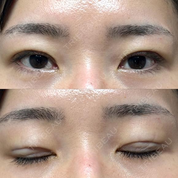 二重埋没 / クマ治療 / 上まぶたの脂肪取り / 下まぶたの脂肪取り NARU Beauty Clinic 【ナルクリ】 DAY 65 メイン用