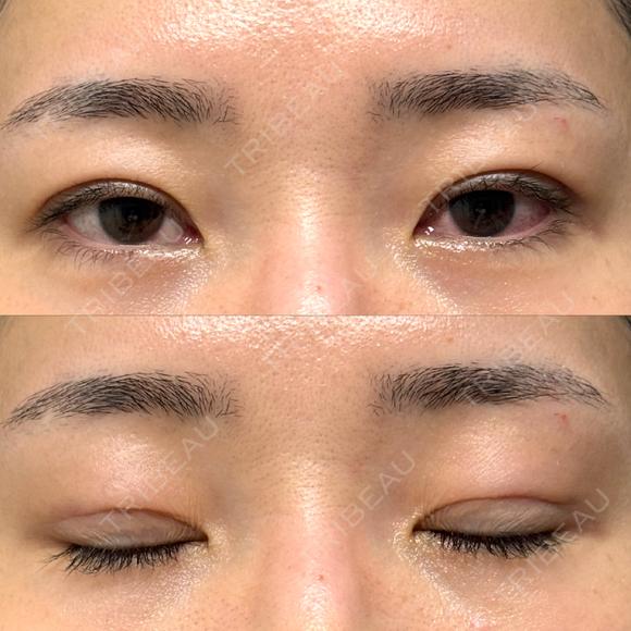 二重埋没 / クマ治療 / 上まぶたの脂肪取り / 下まぶたの脂肪取り NARU Beauty Clinic 【ナルクリ】 DAY 66 メイン用
