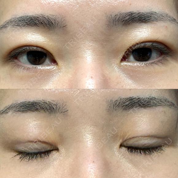 二重埋没 / クマ治療 / 上まぶたの脂肪取り / 下まぶたの脂肪取り NARU Beauty Clinic 【ナルクリ】 DAY 67 メイン用