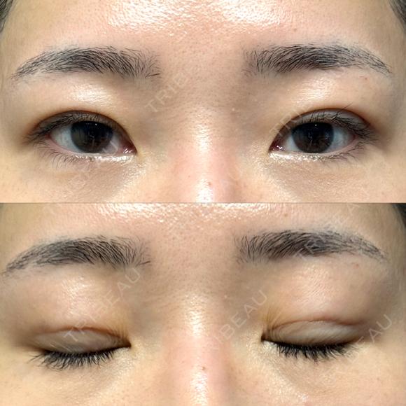 二重埋没 / クマ治療 / 上まぶたの脂肪取り / 下まぶたの脂肪取り NARU Beauty Clinic 【ナルクリ】 DAY 68 メイン用