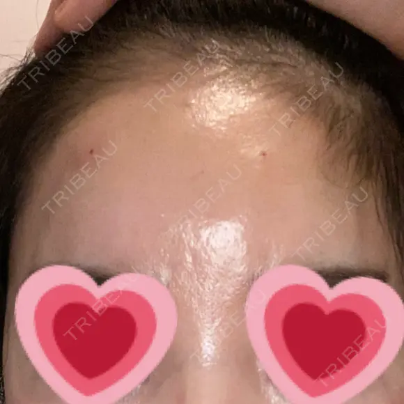 ヒアルロン酸注入（額） 藤・ナチュレ美容クリニック 銀座院 DAY 0 メイン用