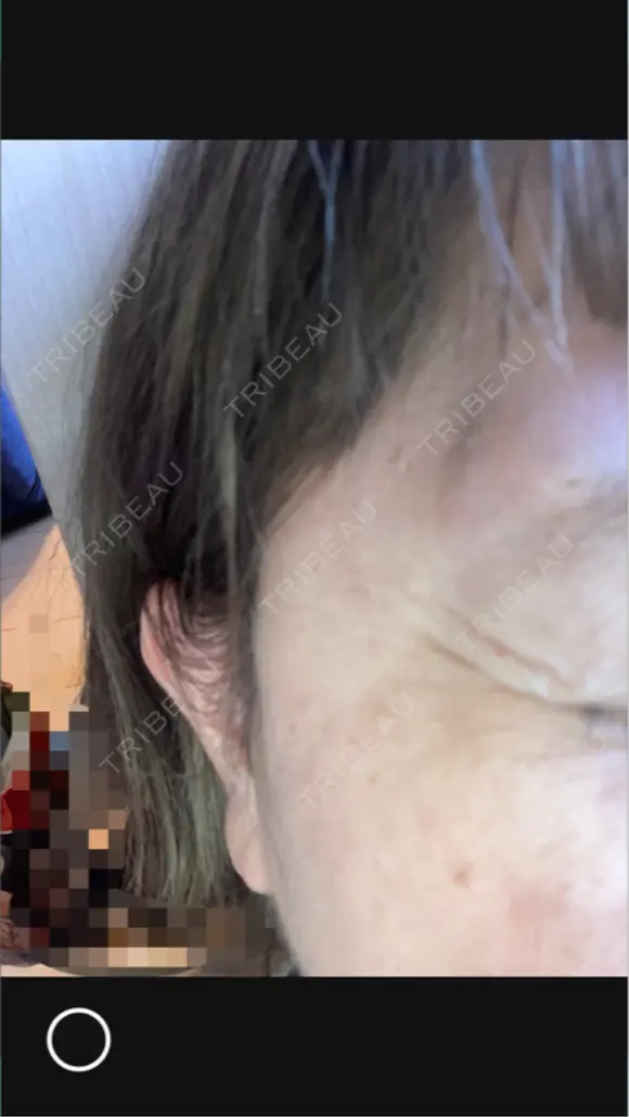 ボトックス（目尻） ROOTS Clinic AFTER メイン用