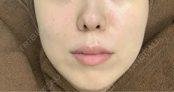 その他（肌） ゆきスキンクリニック 東池袋 AFTER メイン用