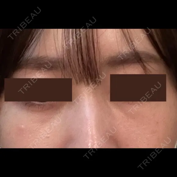 クマ治療 / 下まぶたたるみ取り / 下まぶたの脂肪取り APOLLO BEAUTY CLINIC DAY 23 メイン用