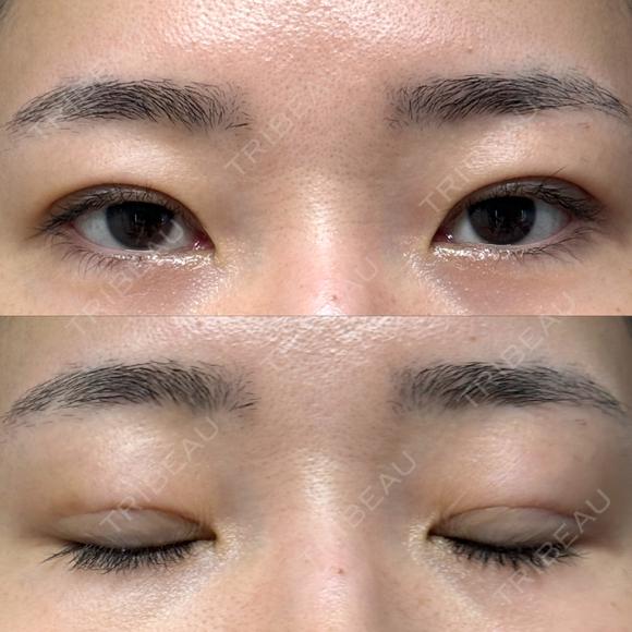 二重埋没 / クマ治療 / 上まぶたの脂肪取り / 下まぶたの脂肪取り NARU Beauty Clinic 【ナルクリ】 DAY 69 メイン用