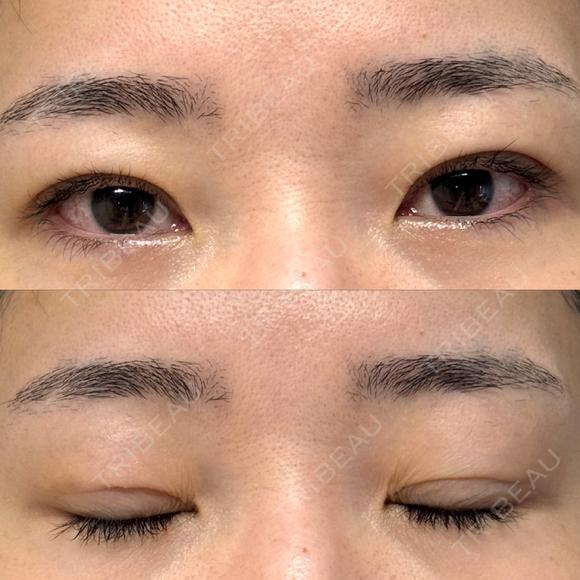 二重埋没 / クマ治療 / 上まぶたの脂肪取り / 下まぶたの脂肪取り NARU Beauty Clinic 【ナルクリ】 AFTER メイン用
