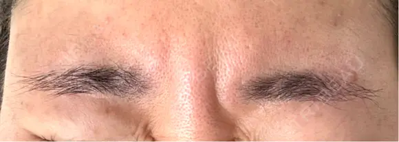 ボトックス（眉間） TCB東京中央美容外科 倉敷院 AFTER メイン用