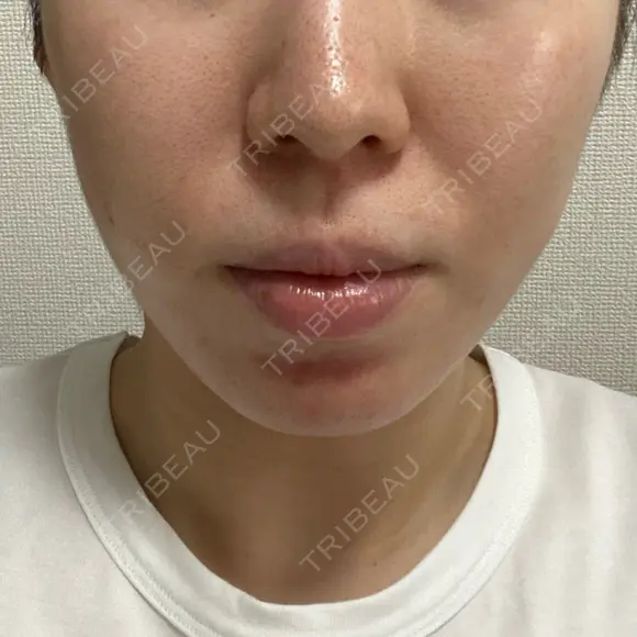糸リフト / 脂肪吸引（顔） EMMA CLINIC（エマクリニック） DAY 31 メイン用