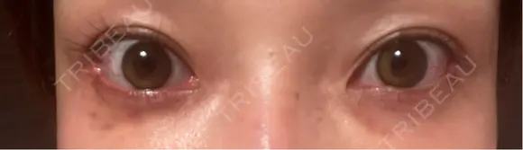 スネコス お肌のクリニック　高田馬場 DAY 9 メイン用