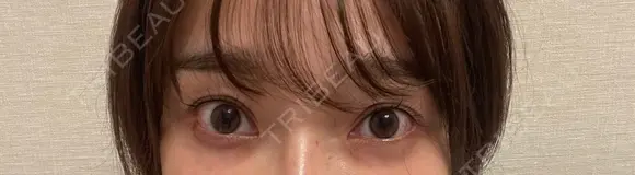 スネコス お肌のクリニック　高田馬場 DAY 15 メイン用