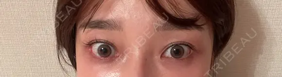 スネコス お肌のクリニック　高田馬場 DAY 17 メイン用