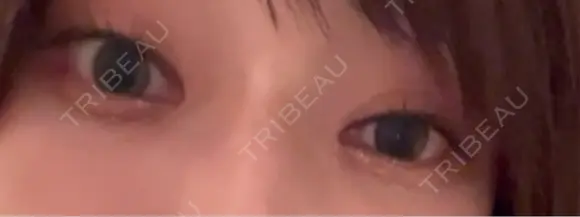 スネコス お肌のクリニック　高田馬場 DAY 21 メイン用