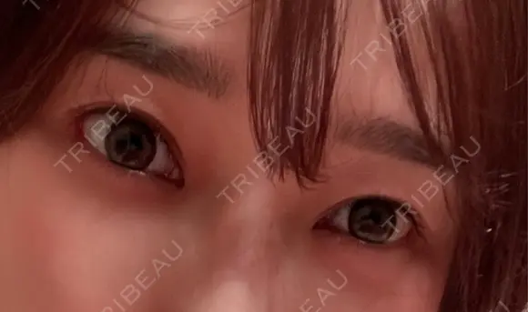 スネコス お肌のクリニック　高田馬場 DAY 14 メイン用