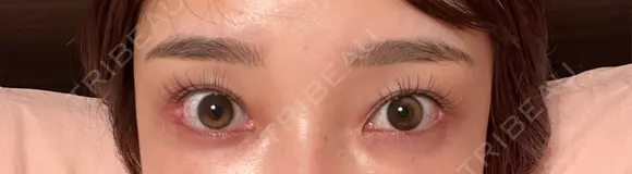 スネコス お肌のクリニック　高田馬場 AFTER メイン用