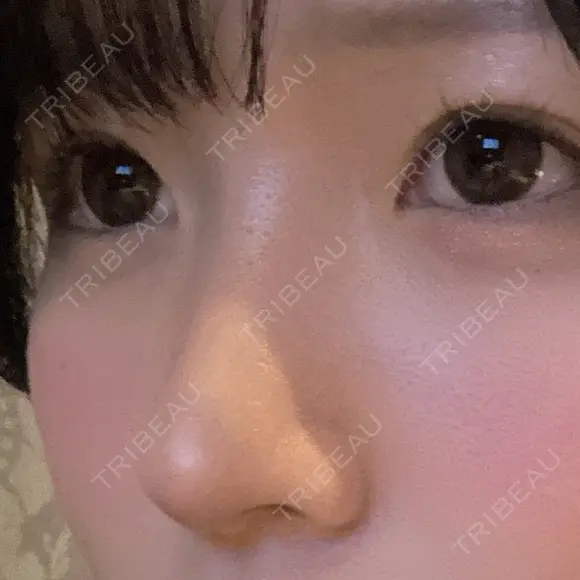 小鼻縮小（切開） / 鼻尖形成（非切開） ASTRA BEAUTY CLINIC DAY 682 メイン用